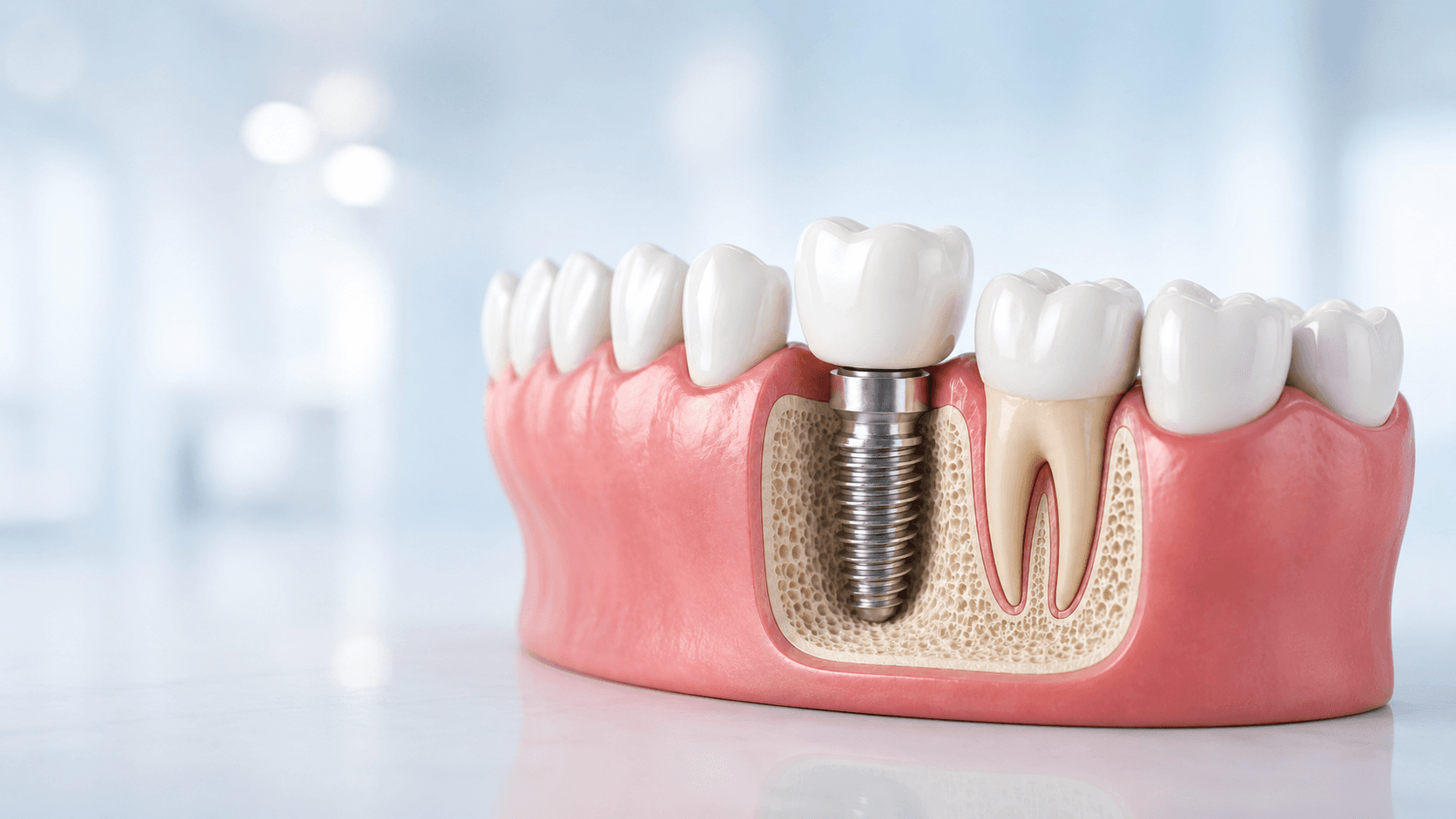 Dental Implants in Canada: Long-Term Solutions for Missing Teeth